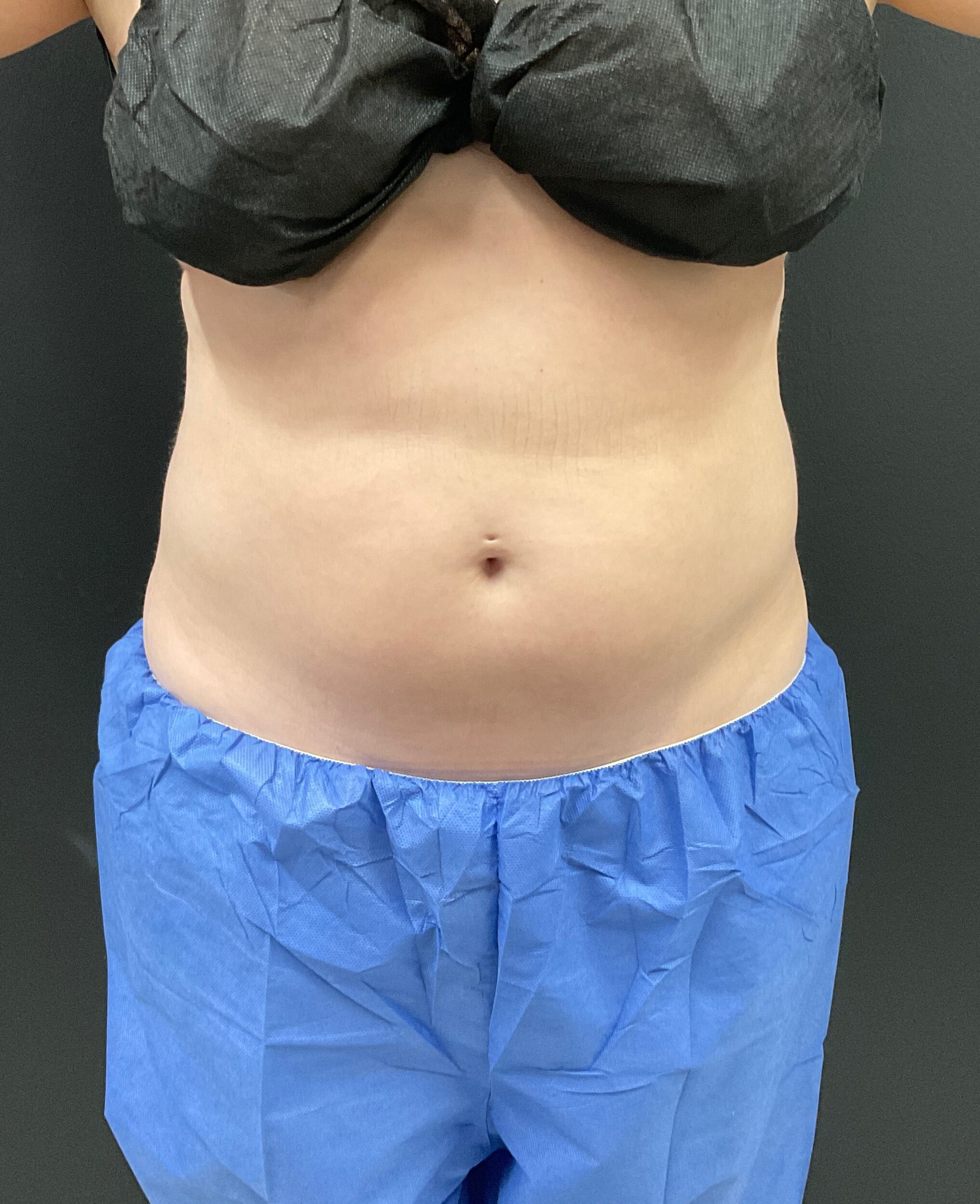 Before Image: CoolTone – Abdomen - front