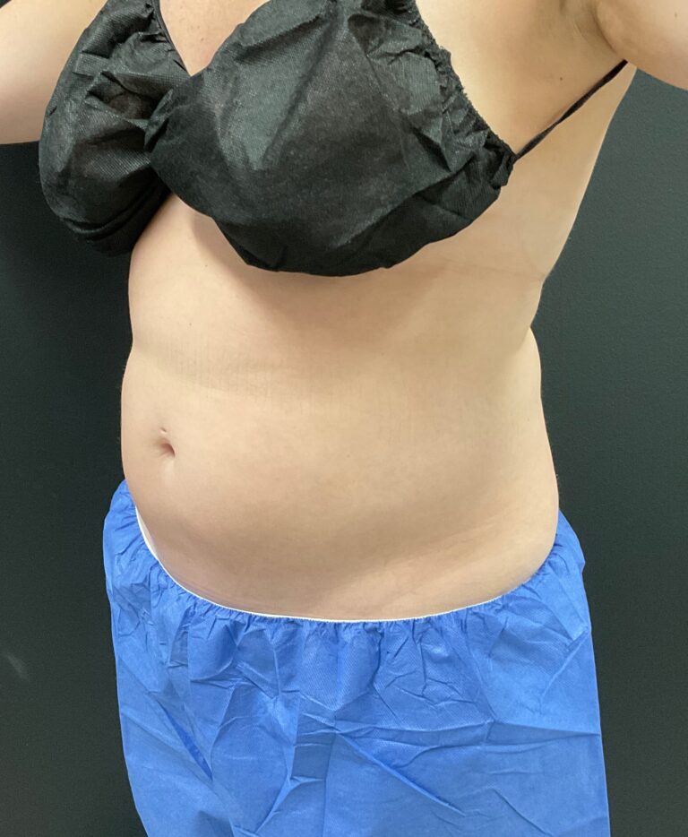 Before Image: CoolTone – Abdomen - left-front-oblique