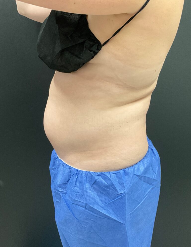 Before Image: CoolTone – Abdomen - left-side