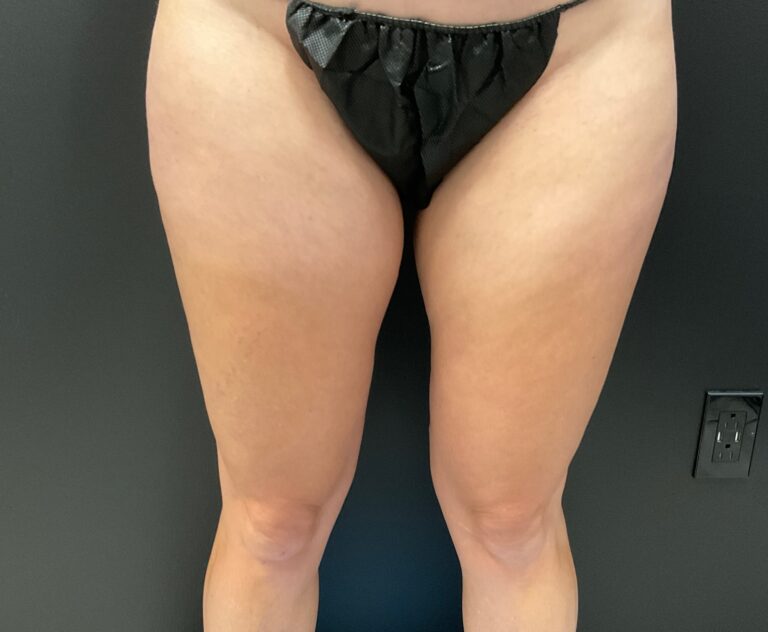 Before Image: CoolTone – Thighs - front