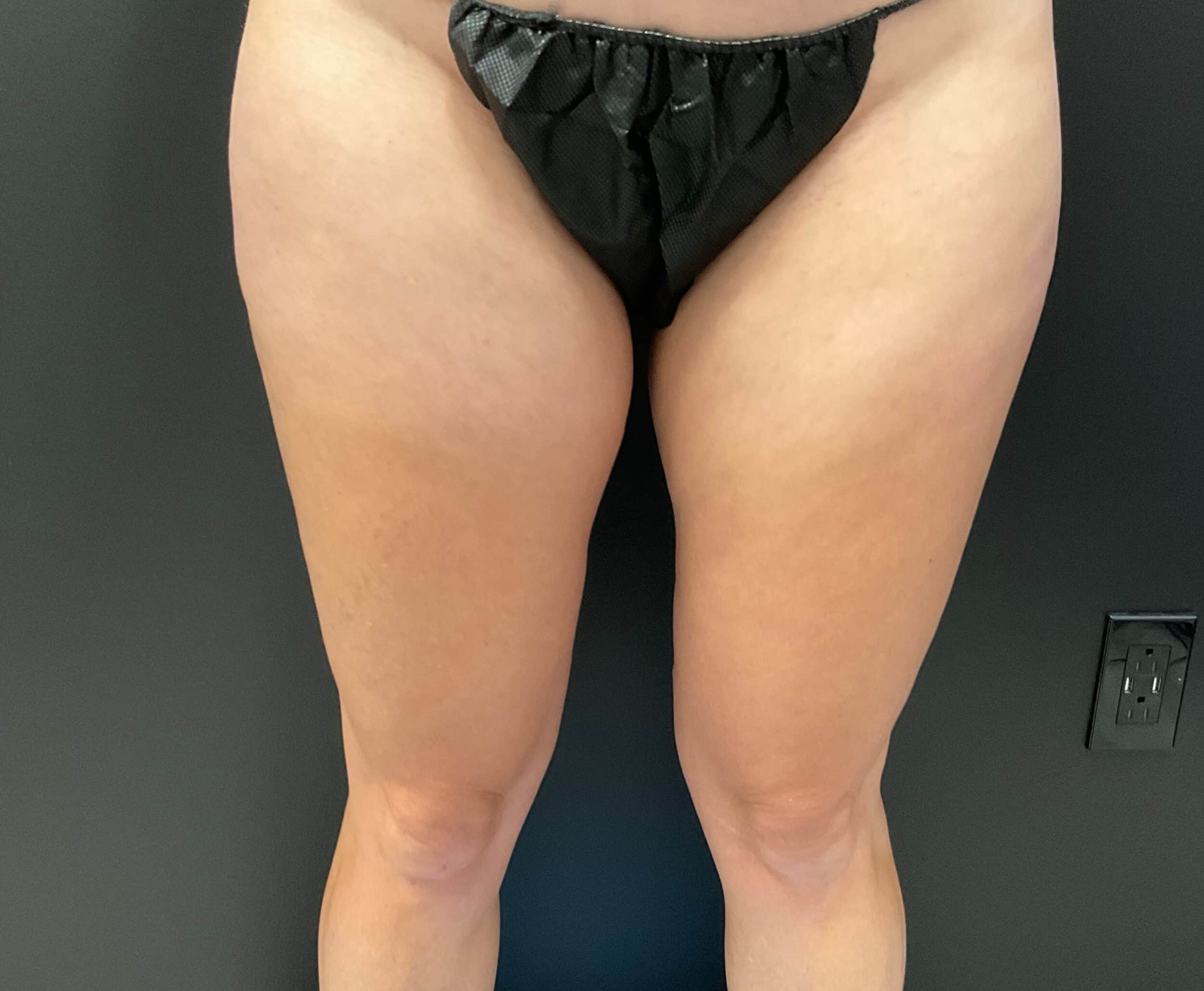 Before Image: CoolTone – Thighs - front