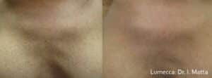 Lumecca IPL Lone Tree CO