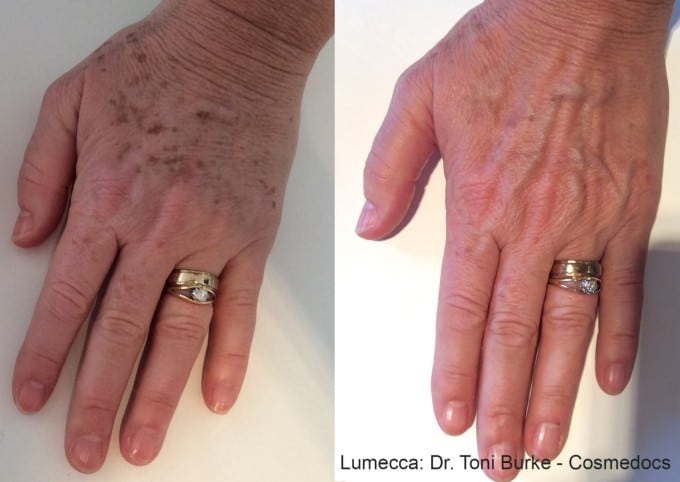 age spots invisible after treatment