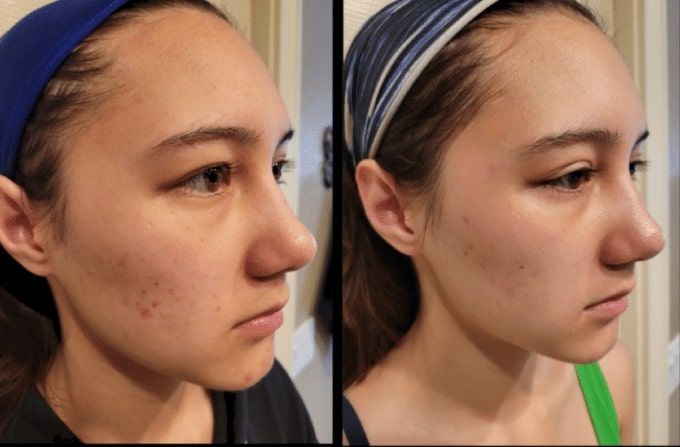 Microdermabrasion Lone Tree CO