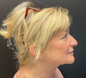 After Image: Hyperdilute Radiesse for lower face and jowls