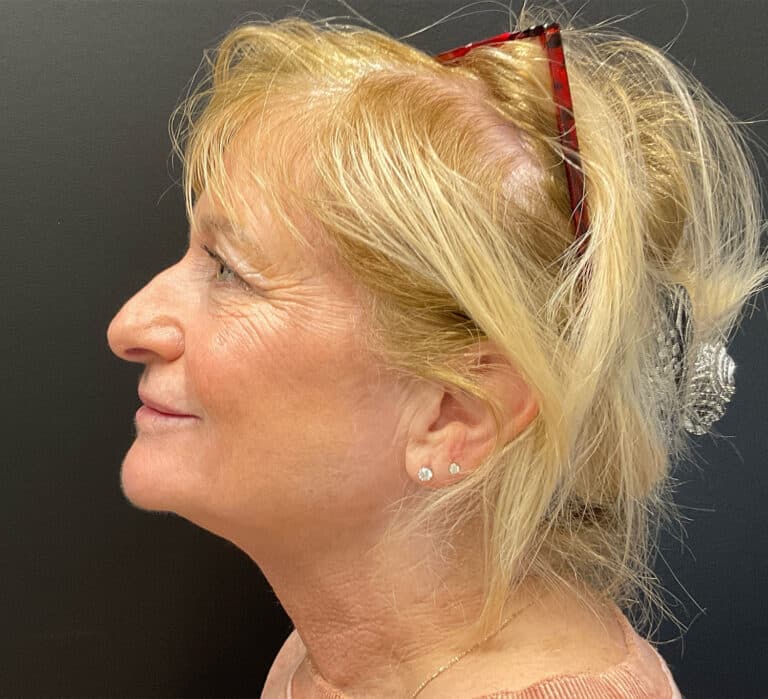 After Image: Hyperdilute Radiesse for lower face and jowls - left-side
