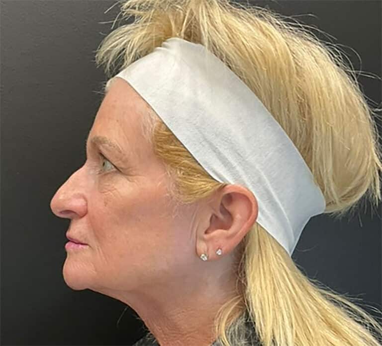 Before Image: Hyperdilute Radiesse for lower face and jowls - left-side