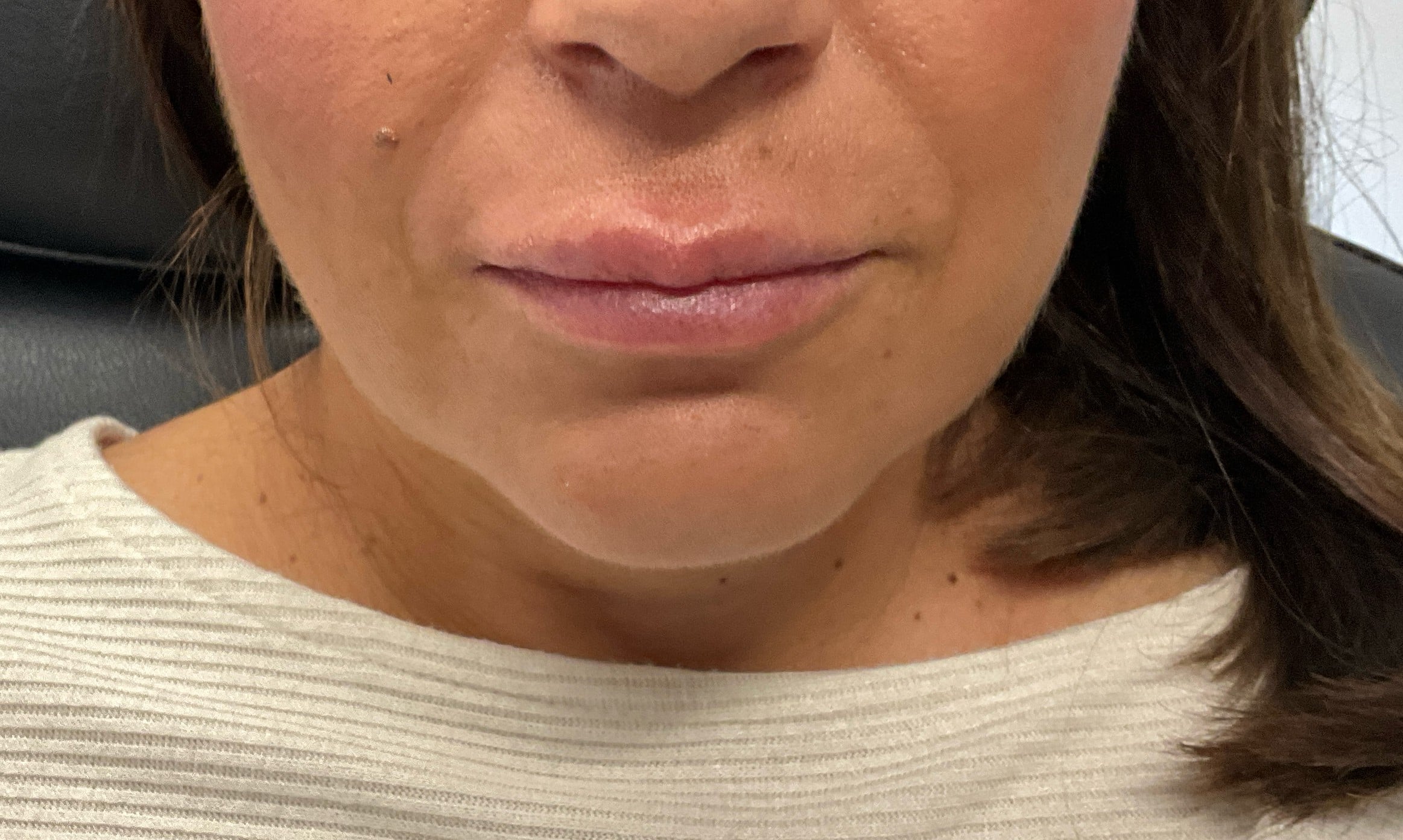 After Image: Dermal Filler – Lips (Versa) - front