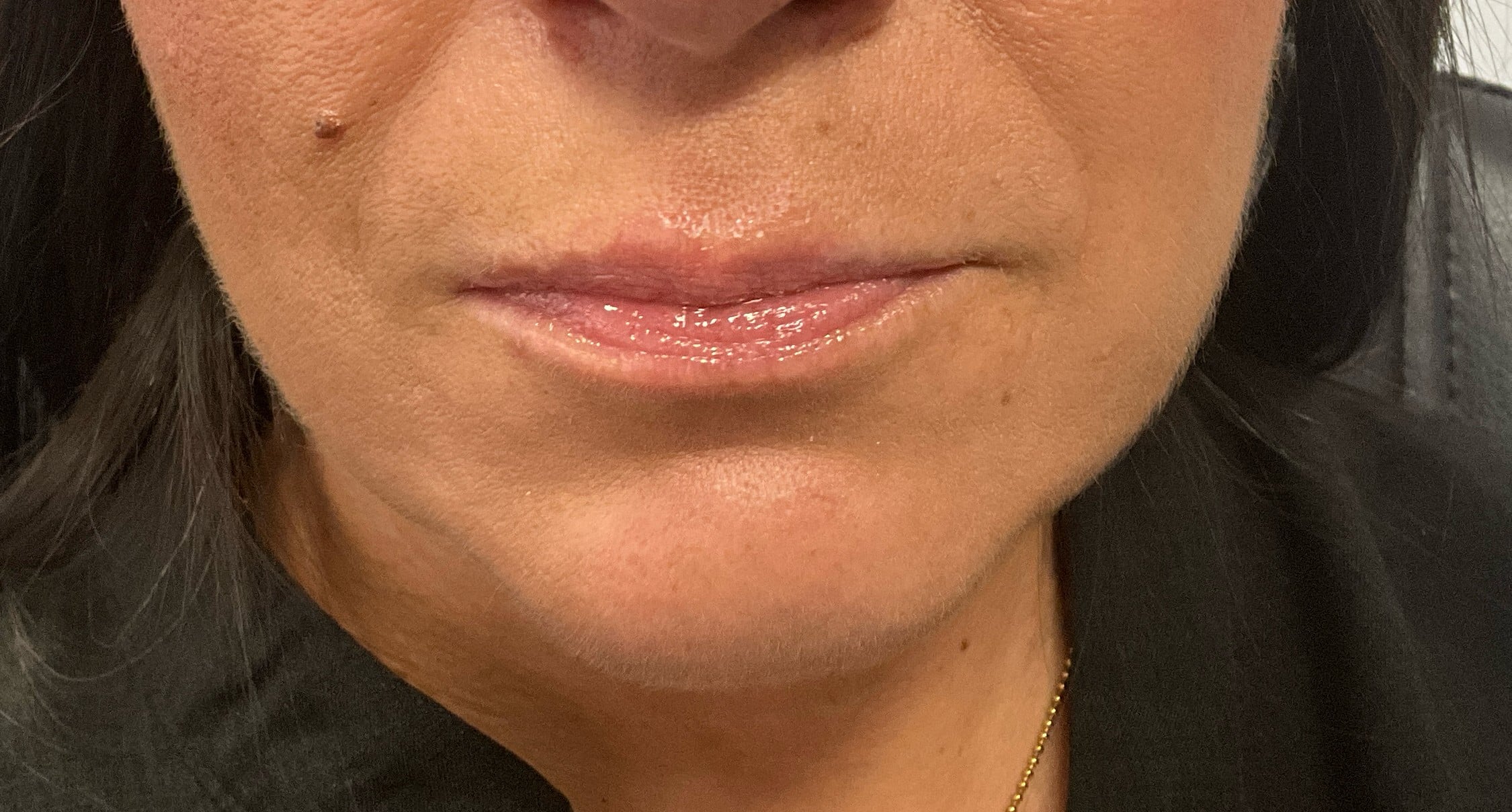 Before Image: Dermal Filler – Lips (Versa) - front