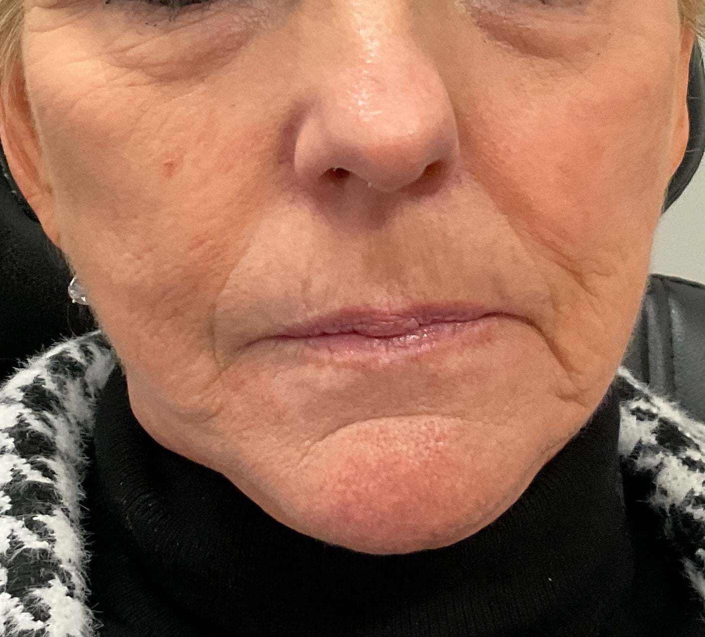 Before Image: Dermal Filler – Lips (Volbella) - front