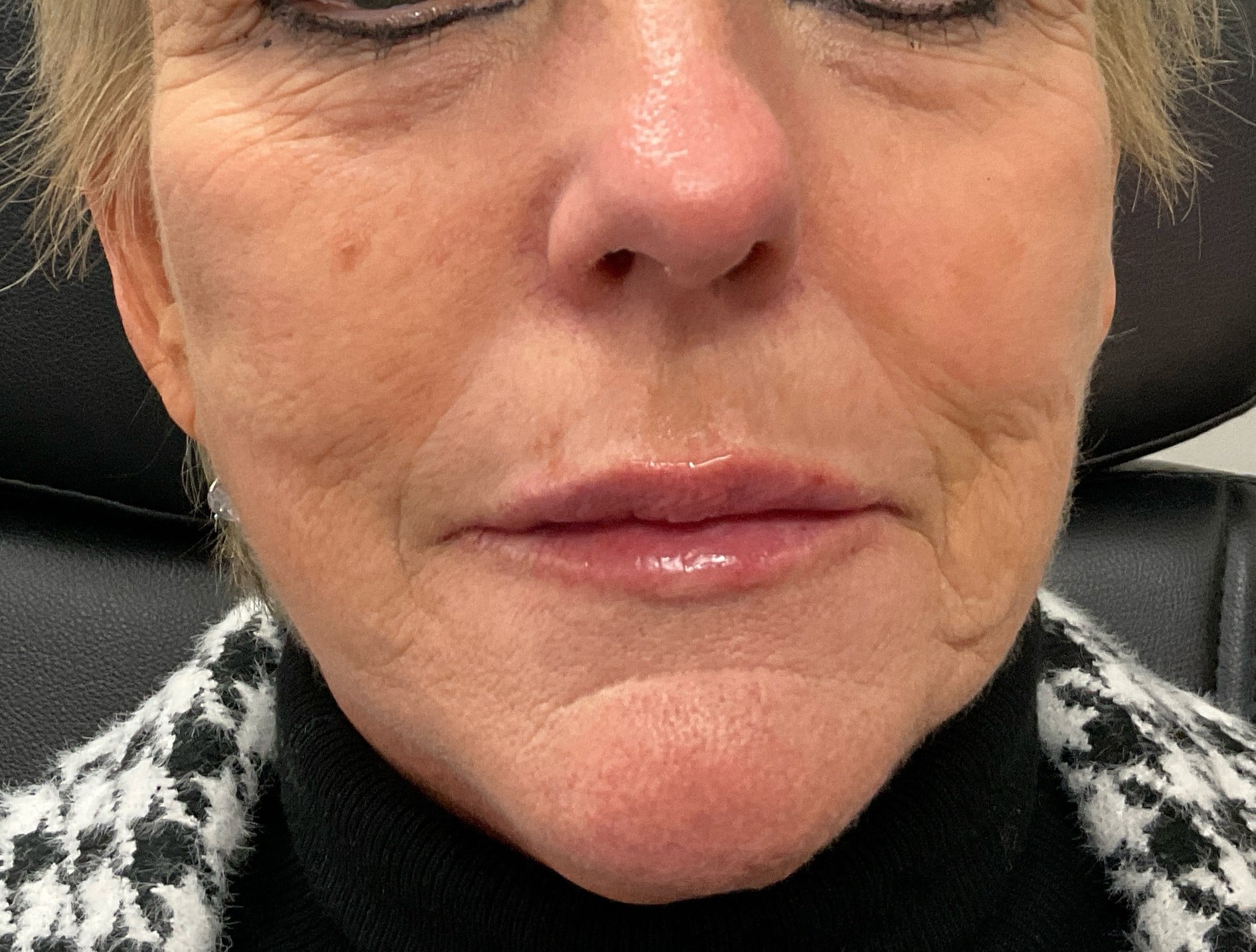 After Image: Dermal Filler – Lips (Volbella) - front