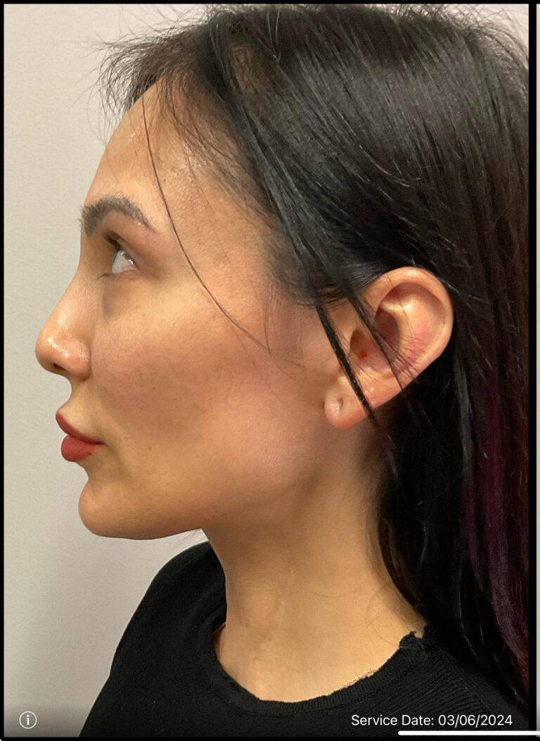 Before Image: Jaw Definition using Juvederm Volux - left-side