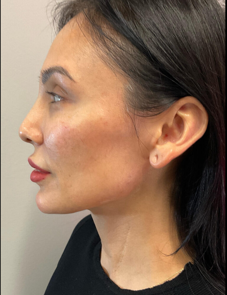 After Image: Jaw Definition using Juvederm Volux - left-side