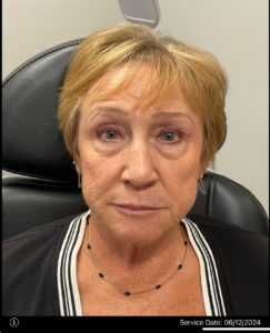 Before Image: Dermal Filler – Cheeks and hyperdilute Radiesse