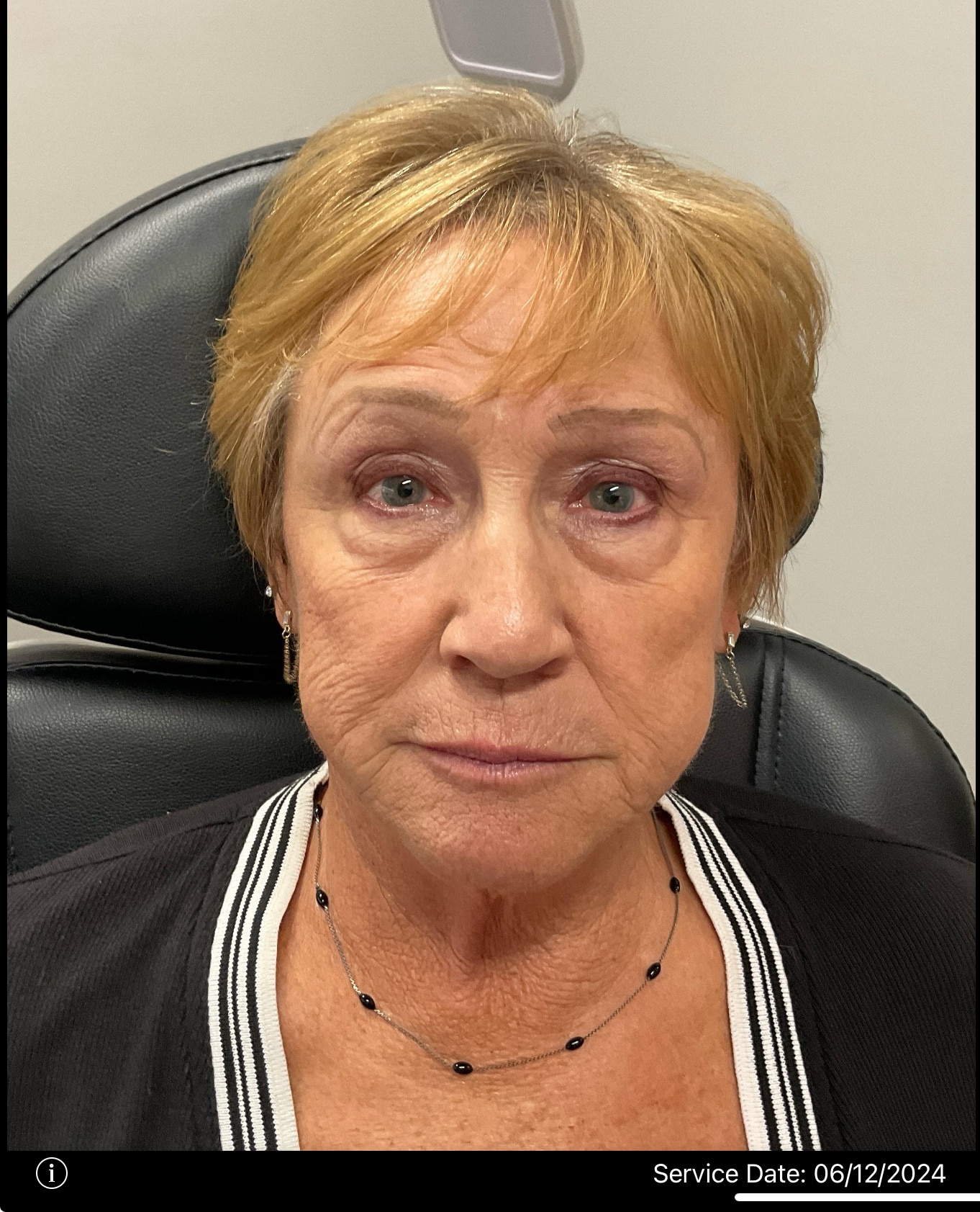 Before Image: Dermal Filler – Cheeks and hyperdilute Radiesse - front