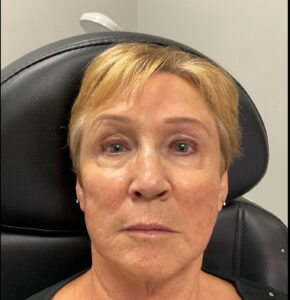 After Image: Dermal Filler – Cheeks and hyperdilute Radiesse
