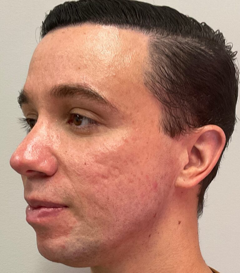 After Image: Cheek and Jawline Filler – Juvederm Voluma and Volux - left-front-oblique