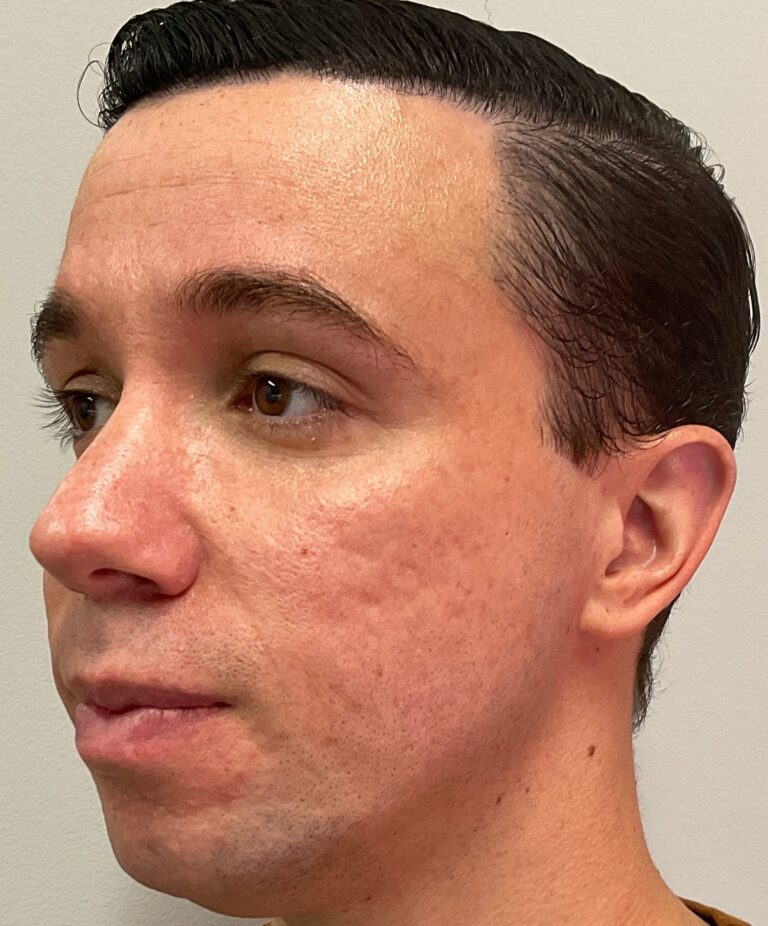 Before Image: Cheek and Jawline Filler – Juvederm Voluma and Volux - left-front-oblique