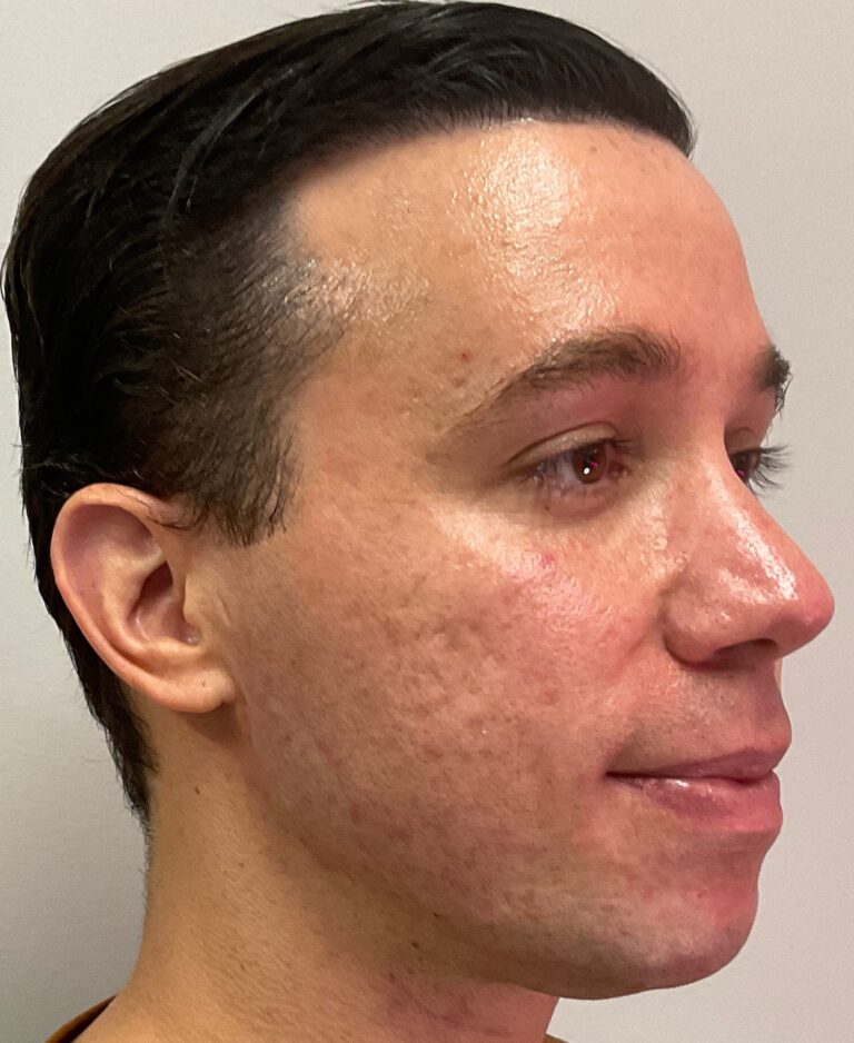 After Image: Cheek and Jawline Filler – Juvederm Voluma and Volux - right-front-oblique