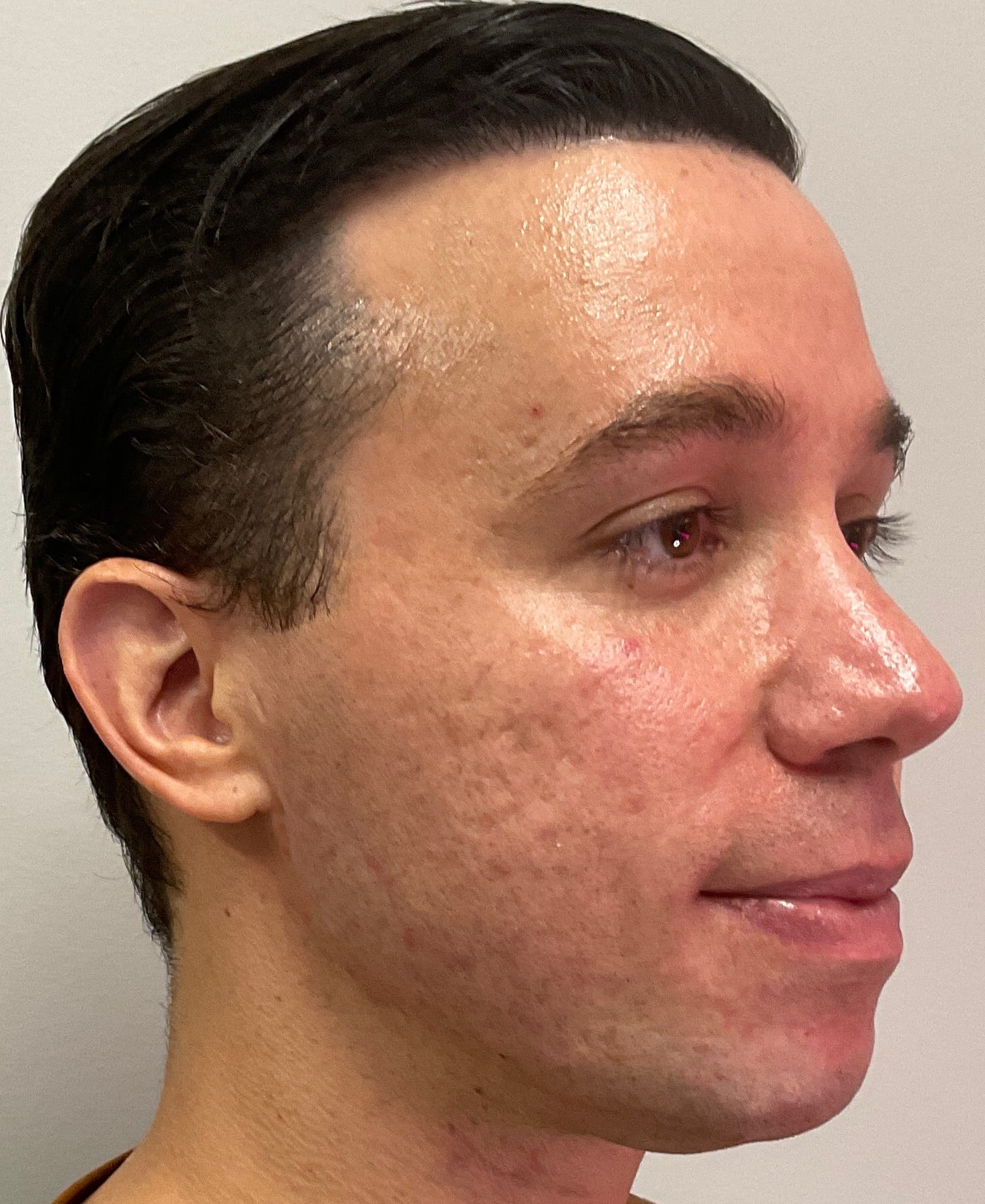After Image: Cheek and Jawline Filler – Juvederm Voluma and Volux - right-front-oblique