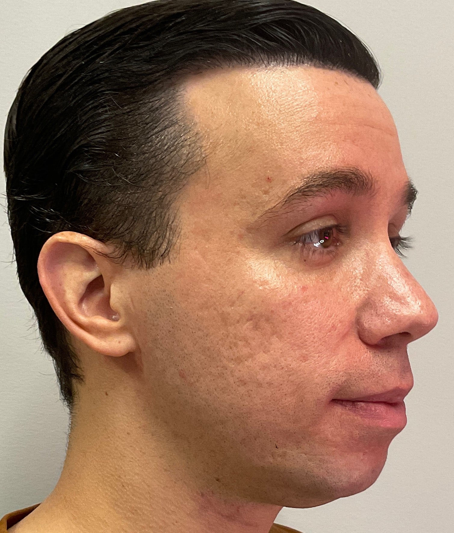 Before Image: Cheek and Jawline Filler – Juvederm Voluma and Volux - right-front-oblique