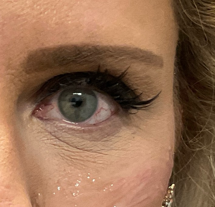 After Image: Upneeq “one eye” challenge - front
