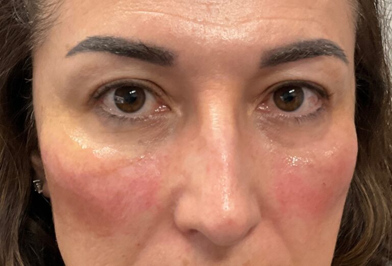 After Image: Cheeks (Radiesse) and Tear Troughs (Belotero) - front