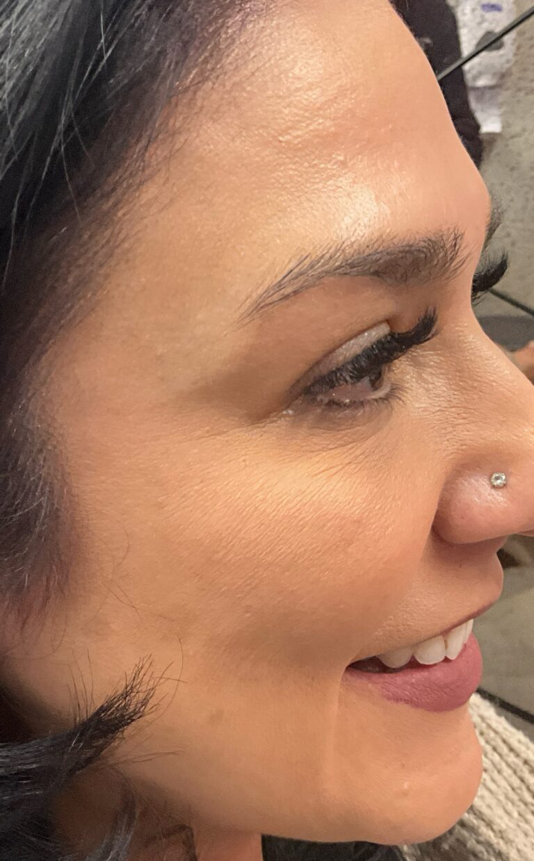 After Image: Botox – Crows Feet - right-side