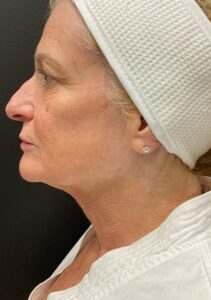 After Image: Hyperdilute Radiesse to lower face and neck