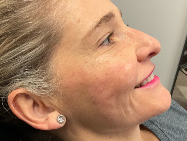 After Image: Hyperdilute Radiesse to lower face - right-side