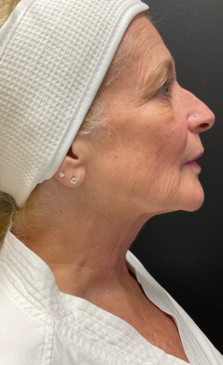 After Image: Hyperdilute Radiesse to lower face and neck - right-side