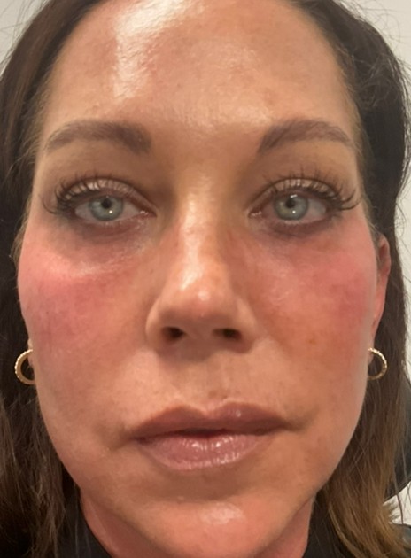 After Image: Tear troughs – Volbella - front