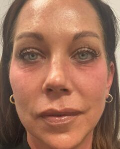 Before Image: Tear troughs – Volbella
