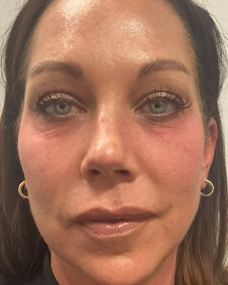 Before Image: Tear troughs – Volbella - front