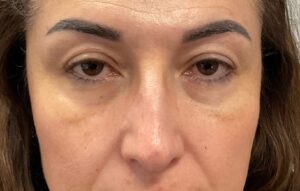 Before Image: Cheeks (Radiesse) and Tear Troughs (Belotero)