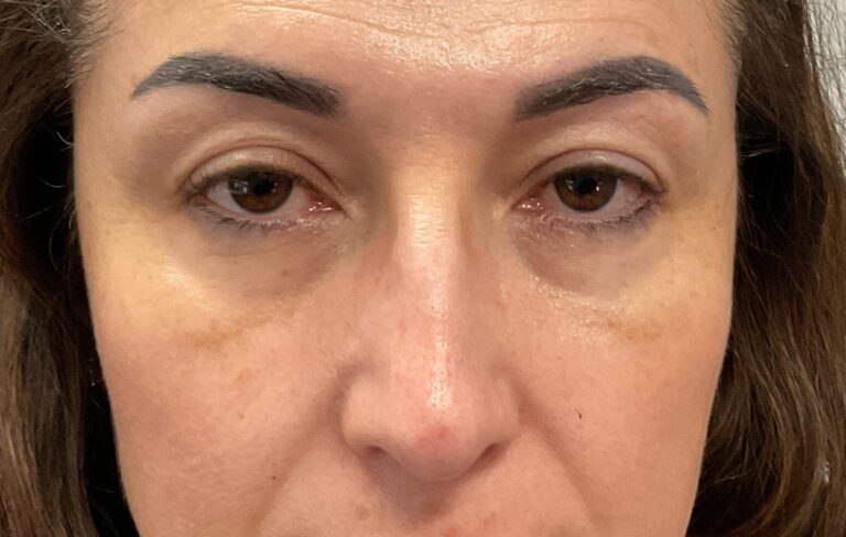 Before Image: Cheeks (Radiesse) and Tear Troughs (Belotero) - front
