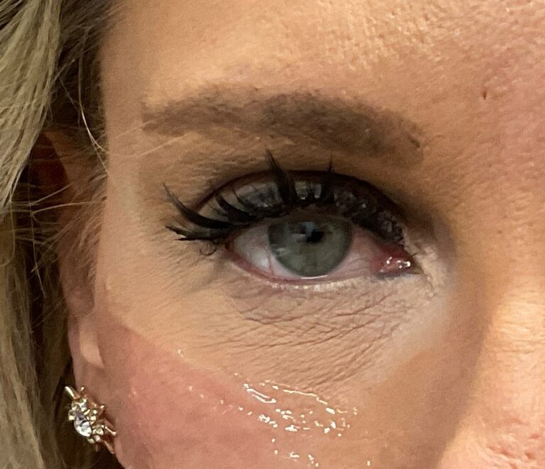 Before Image: Upneeq “one eye” challenge - front
