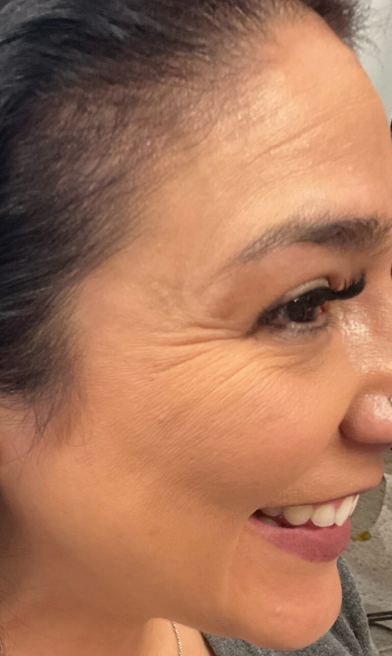 Before Image: Botox – Crows Feet - right-side
