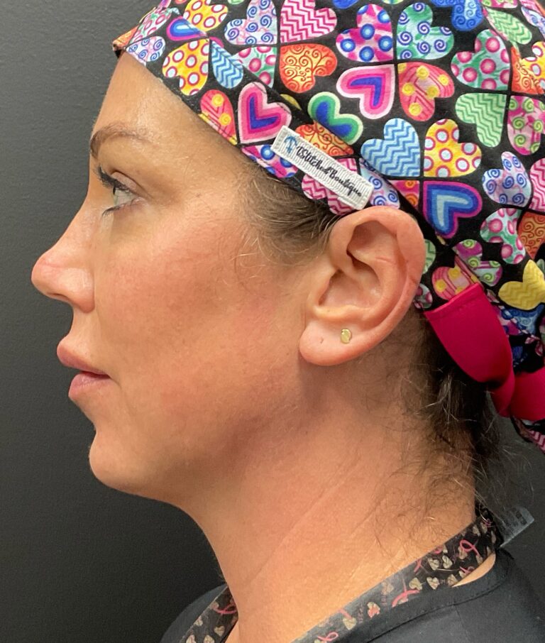 Before Image: Chin (Volux) and Lower Lip (Volbella) - left-side