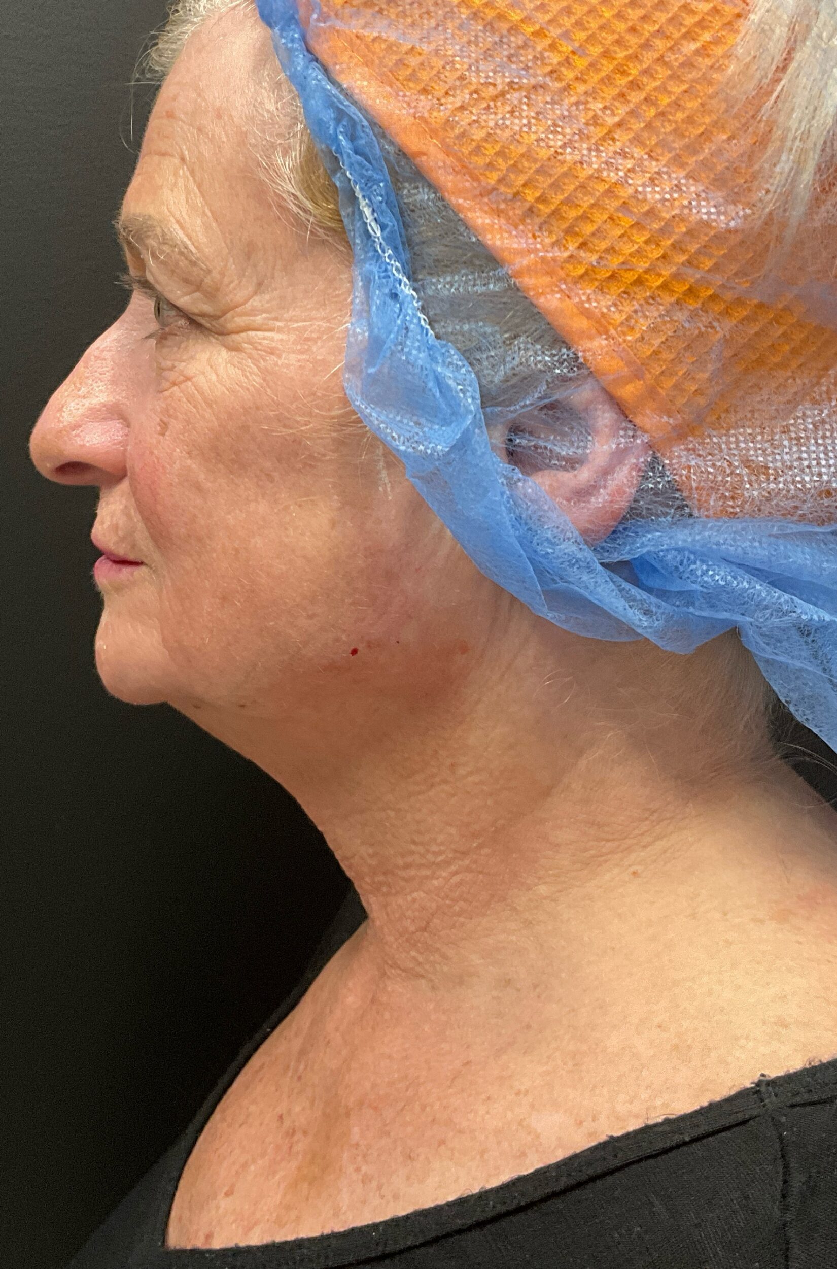 Before Image: Hyperdilute Radiesse to lower face and neck - left-side