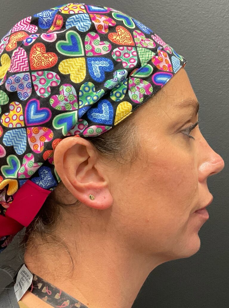 Before Image: Chin (Volux) and Lower Lip (Volbella) - right-side
