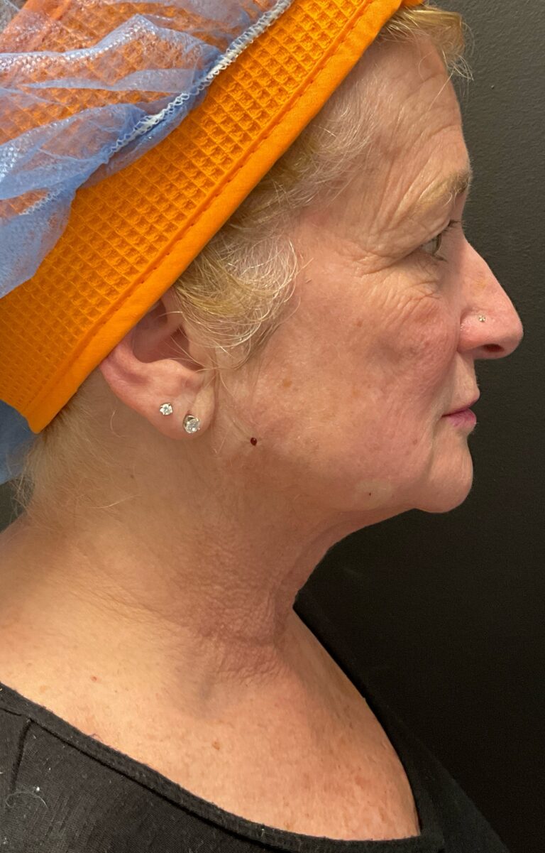 Before Image: Hyperdilute Radiesse to lower face and neck - right-side