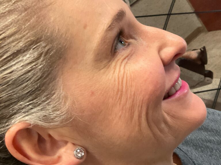 Before Image: Hyperdilute Radiesse to lower face - right-side