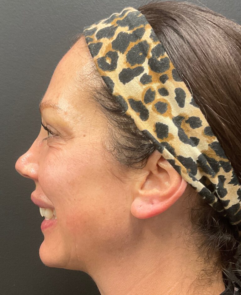 Before Image: Dermal Filler – Volux (jaw) - left-side