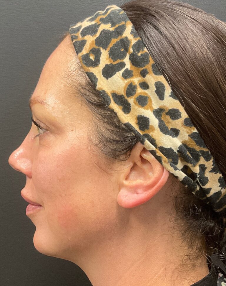 After Image: Dermal Filler – Volux (jaw) - left-side