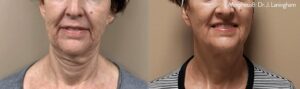 Morpheus8 RF Microneedling Lone Tree CO