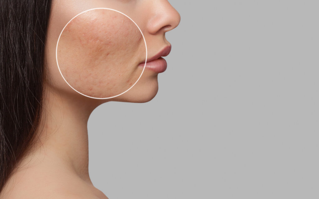 Closeup of acne scars on woman's cheek
