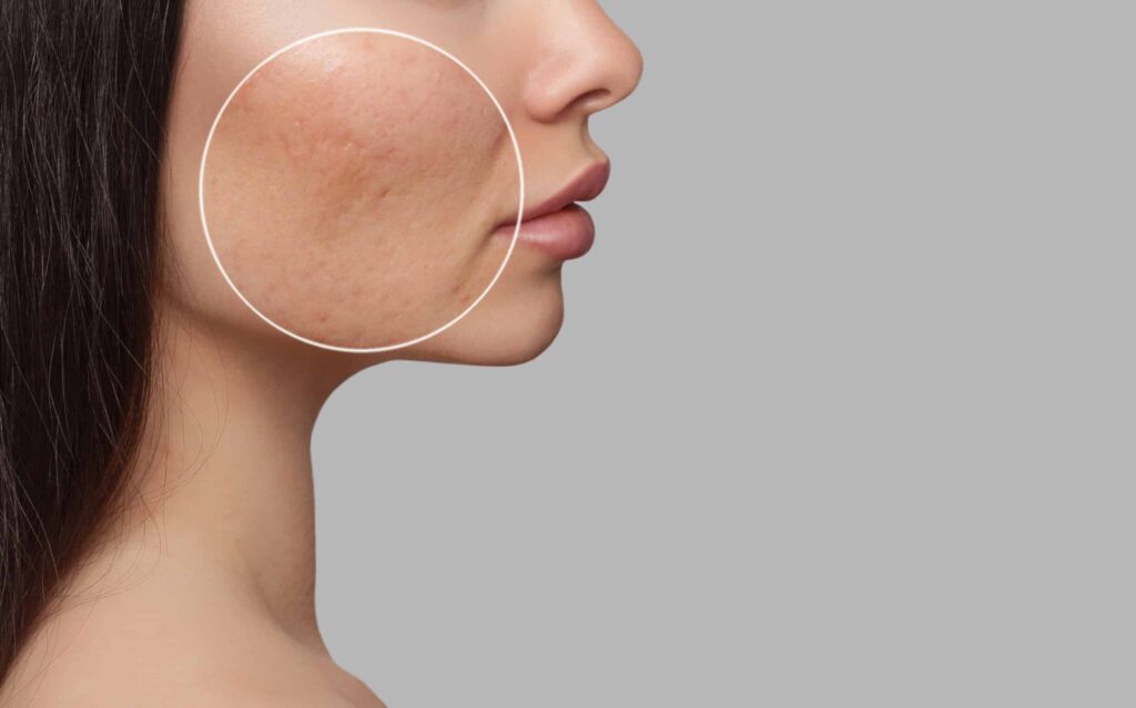 Closeup of acne scars on woman's cheek