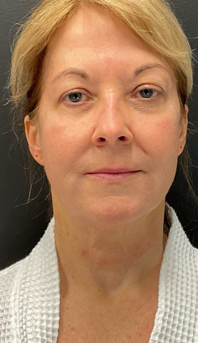 Before Image: Morpheus8 – Face and Neck - front