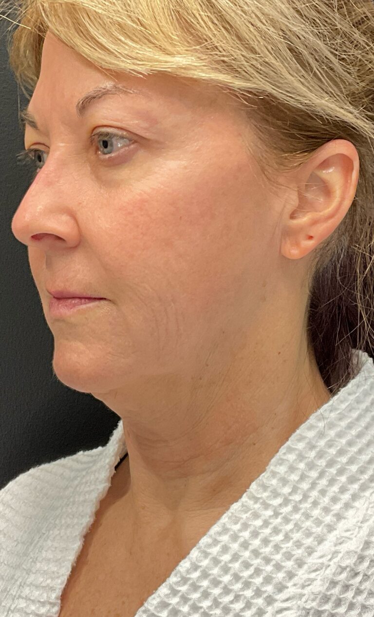 Before Image: Morpheus8 – Face and Neck - left-front-oblique